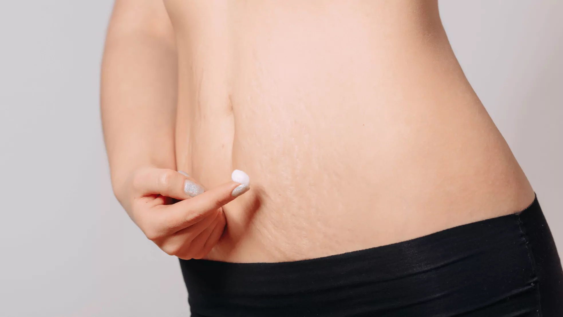 PRP stretch mark treatment procedure at Agelock