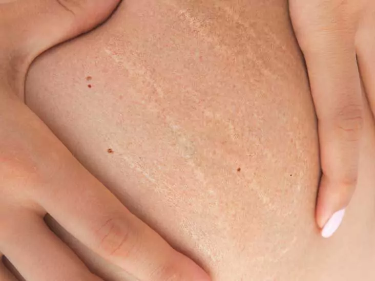 Vivace stretch marks treatment on legs