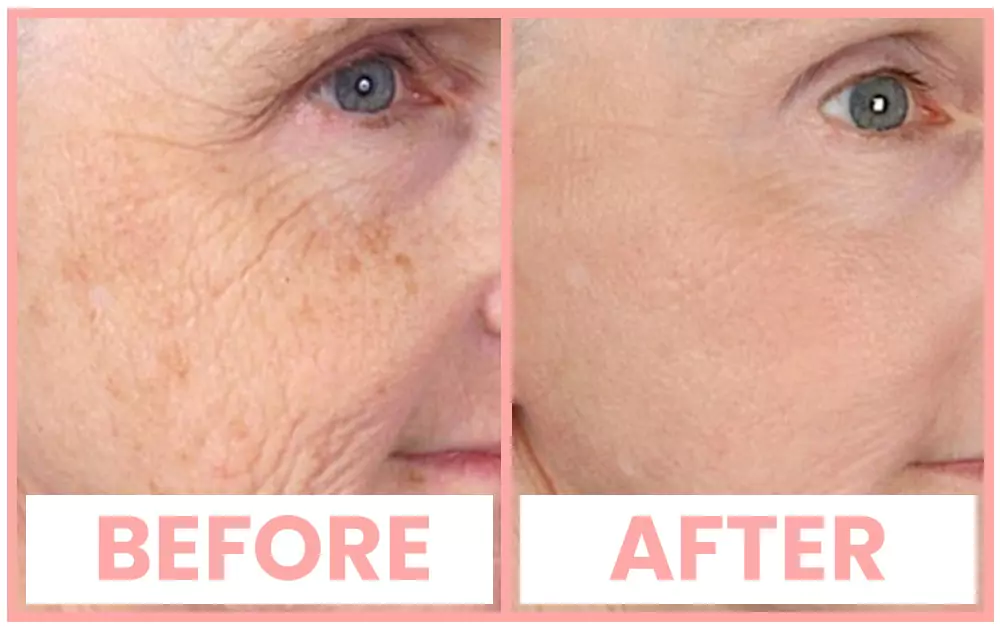 Vivace anti-aging treatment before and after