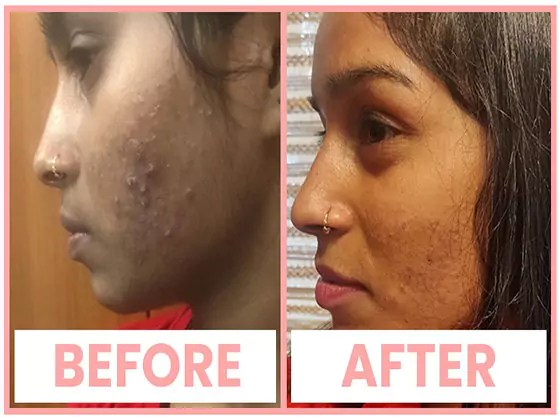 Chemical Peels for Acne Treatment in Chandigarh
