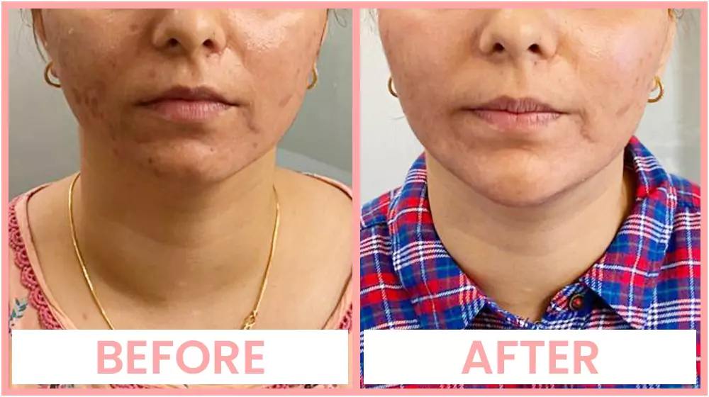 Chin Enhancement in Chandigarh