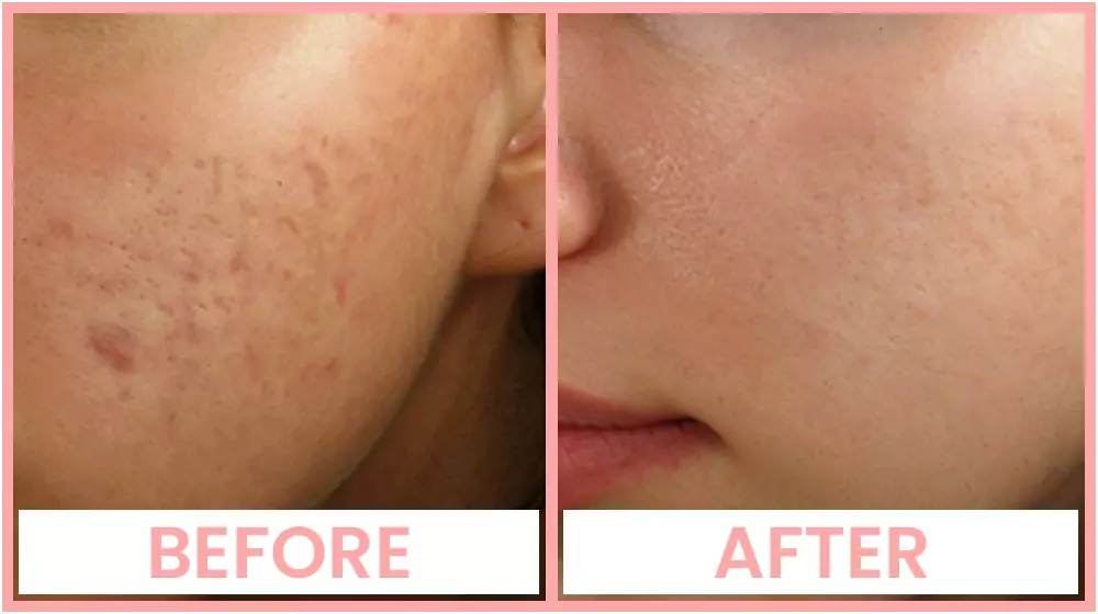 Collagen Induction Therapy in Chandigarh