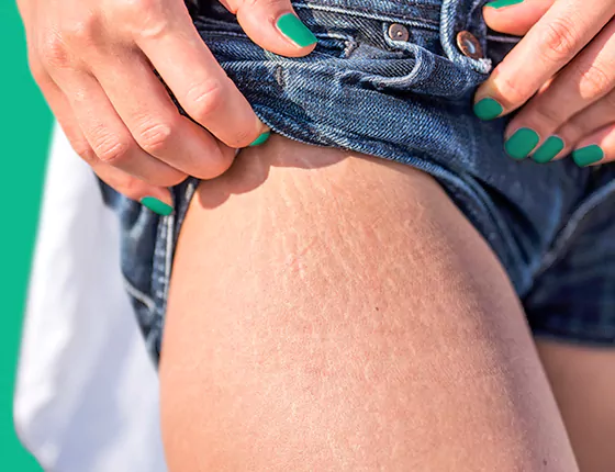 common-triggers-for-stretch-marks Common triggers for stretch marks