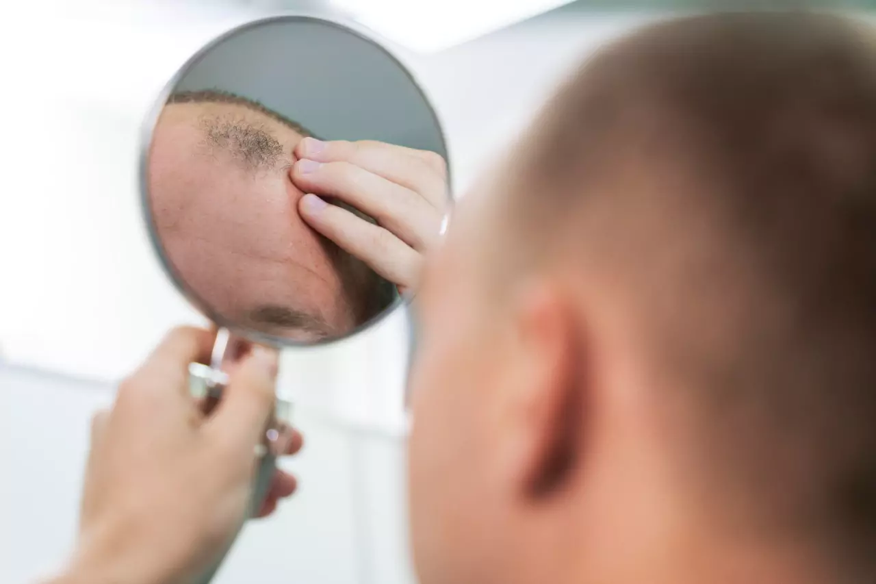 Fue Hair Transplant in Chandigarh