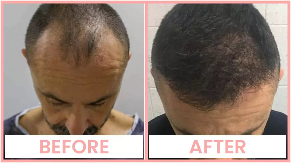 Fue Hair Transplant in Chandigarh