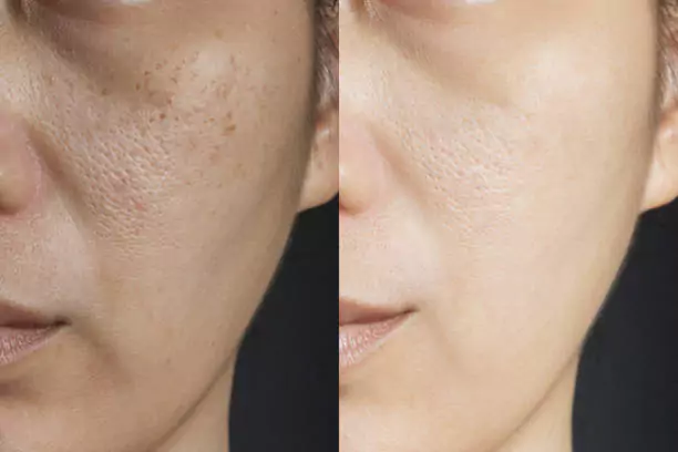 Glutathione Therapy