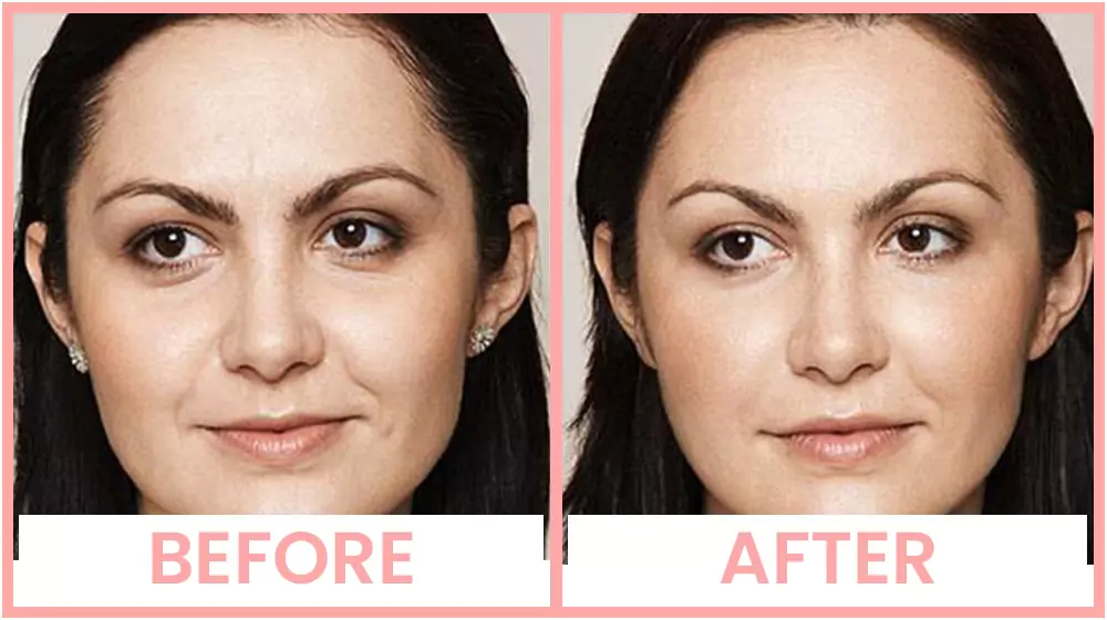 hyaluronic-acid-therapy-beforeandafter Hyaluronic Acid Therapy In Chandigarh