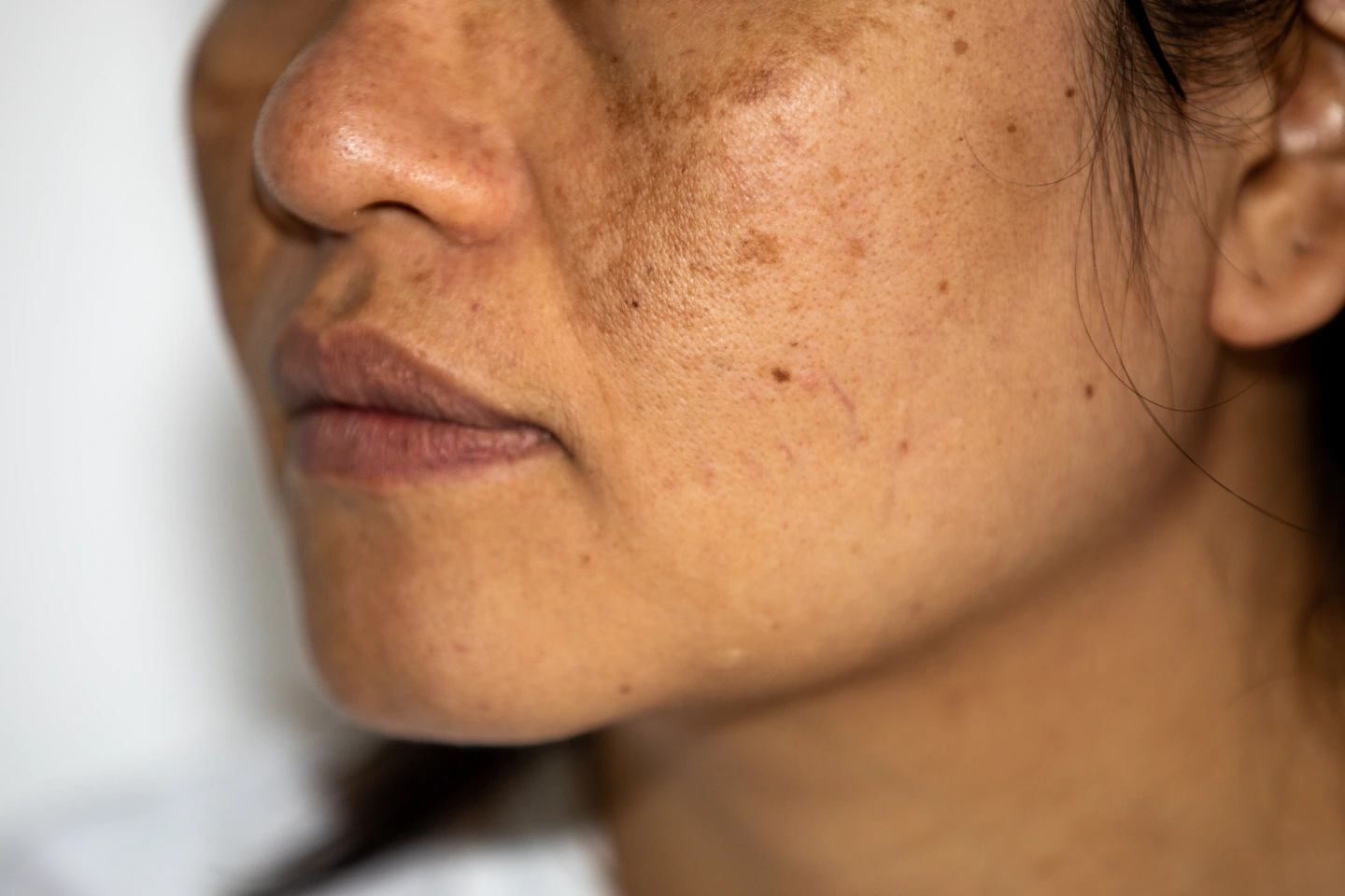 imrs Meline peel procedure at Agelock