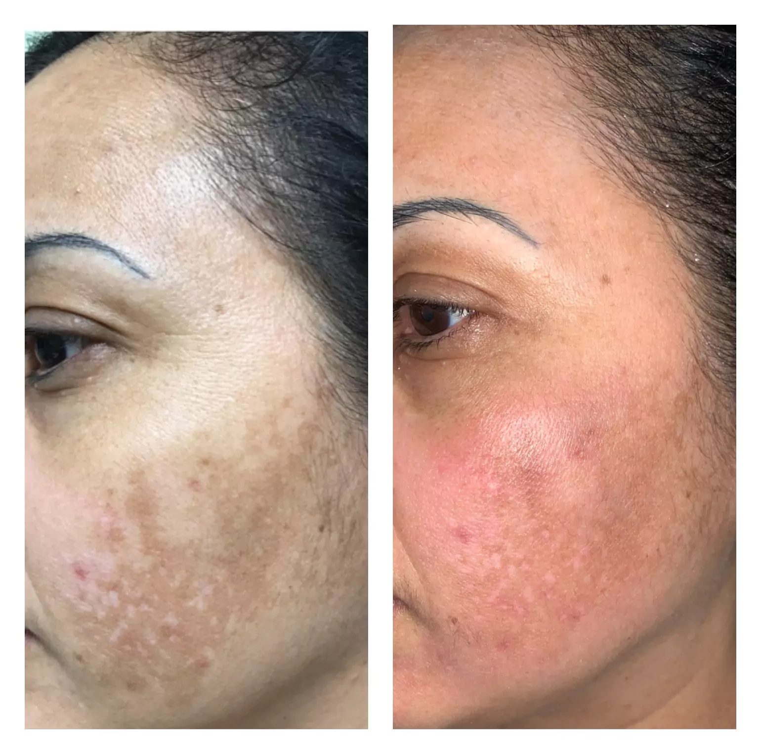 Laser toning before and after results
