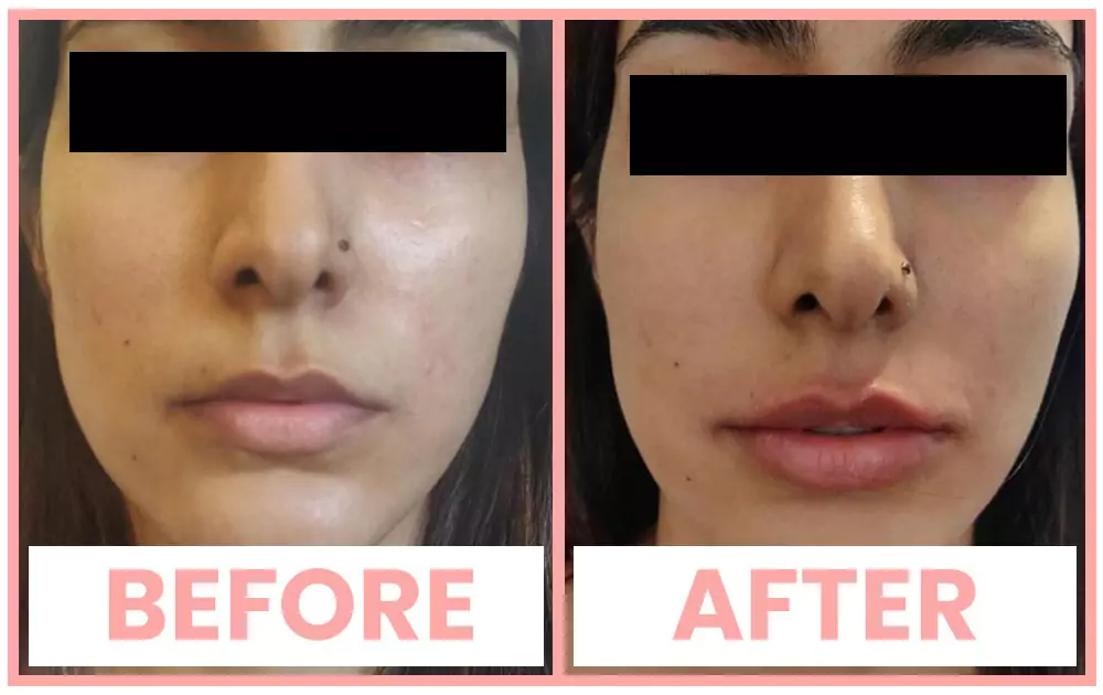 Lip enhancement before and after at Agelock
