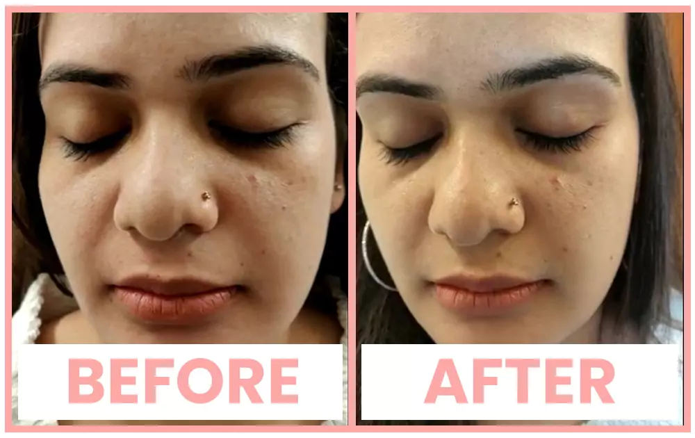 meline-ba Meline peel before and after results