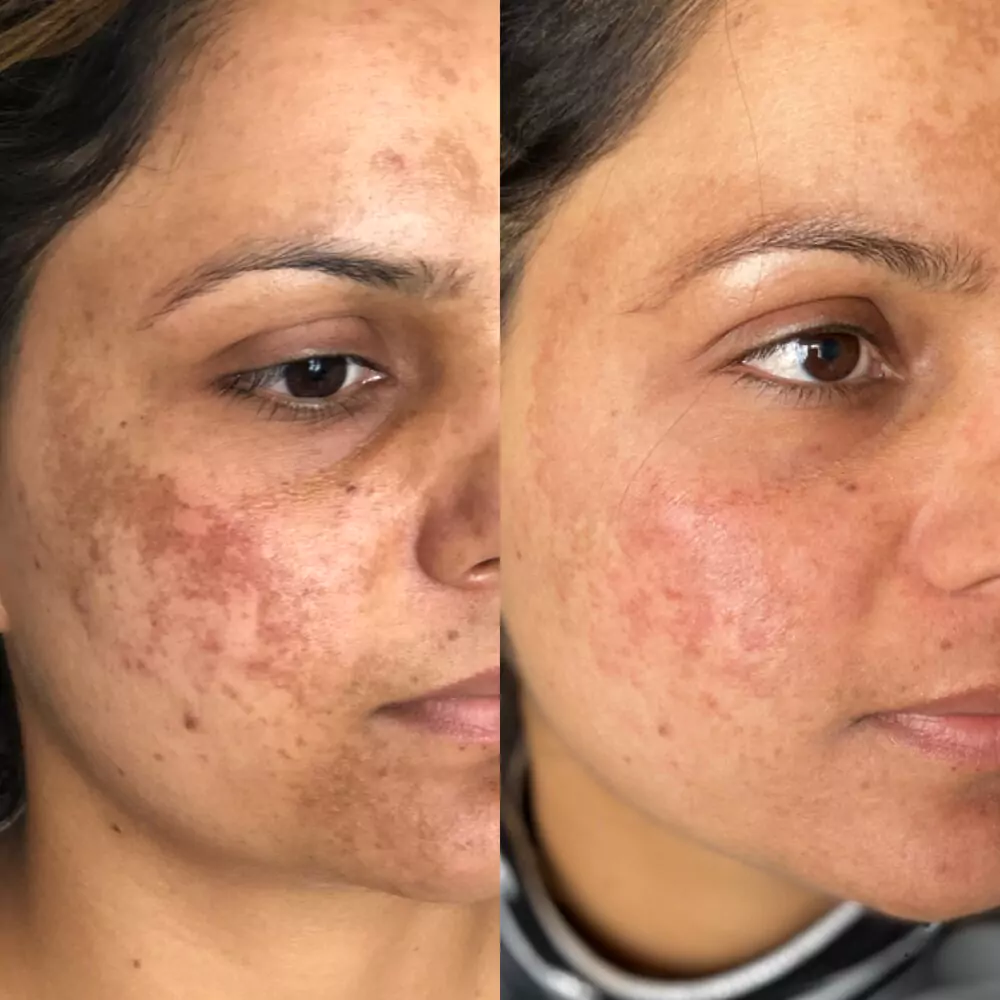 meline-tratement-ba Mesotherapy before and after results