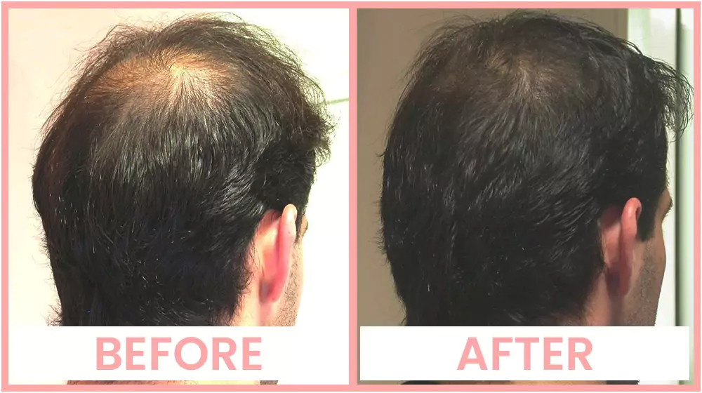 Mesotherapy for hair loss results