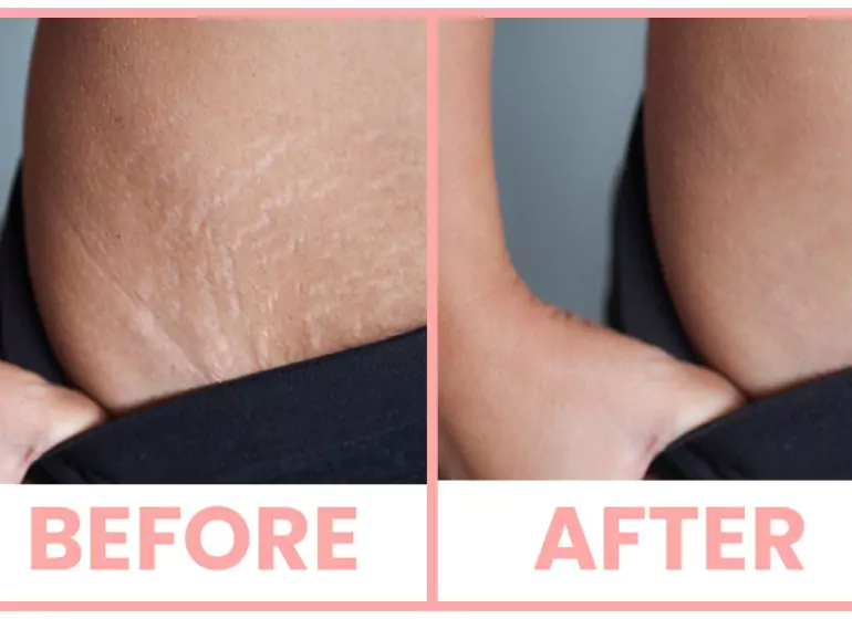 Types of microneedling RF treatment