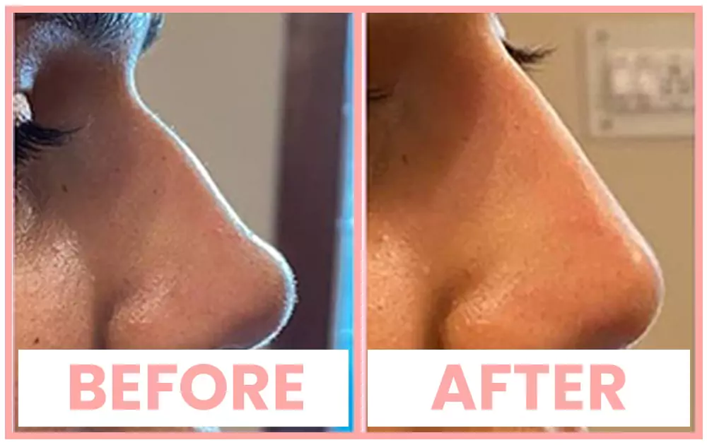 Nose enhancement before and after results