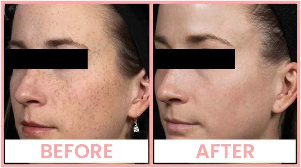 Photo facial before and after results