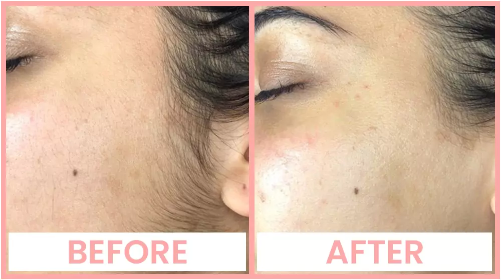Dermaplaning