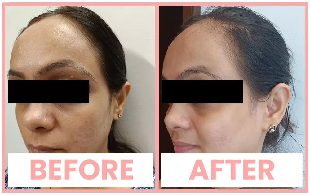 premium-services-vivace-ba Vivace treatment before and after