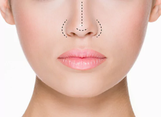 Nose thread lift treatment at Agelock