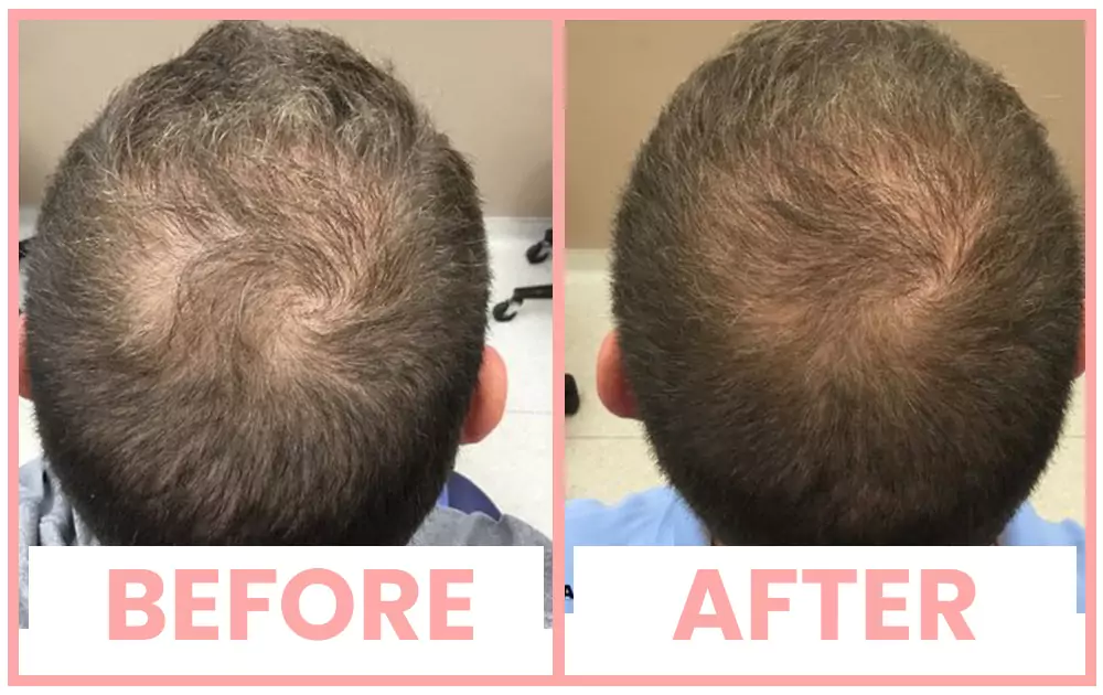 Stem cell injections for hair loss at Agelock