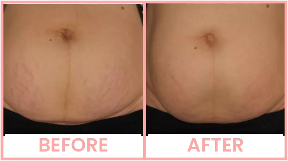 Vivace stretch marks treatment before and after