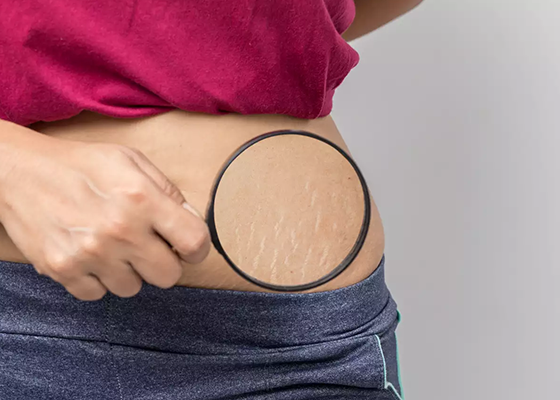 stretch-marks-treatment Stretch marks treatment at Agelock Chandigarh