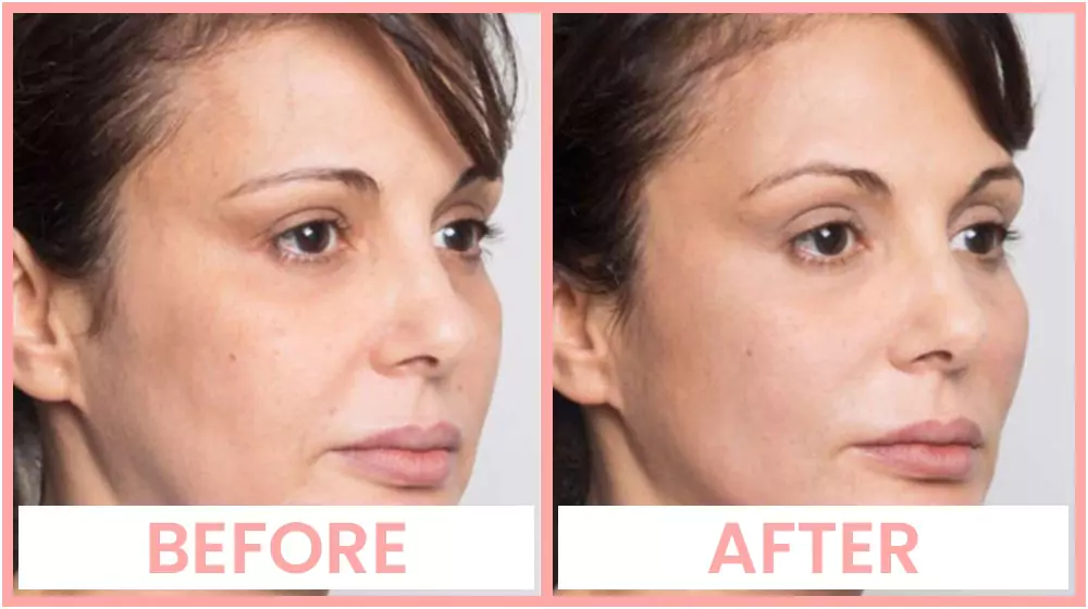Face thread lift before and after