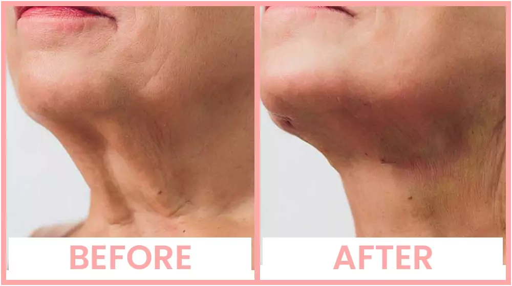 Neck thread lift before and after
