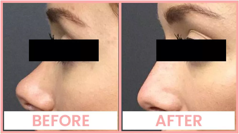 Nose thread lift before and after