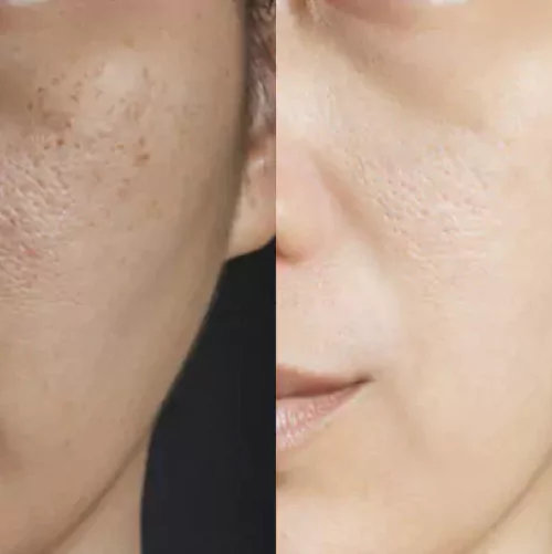 Glutathione Therapy