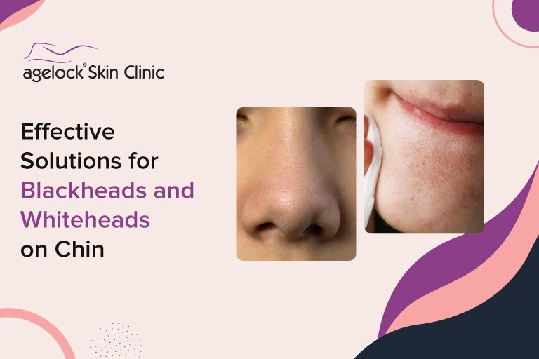 Effective Solutions for Blackheads and Whiteheads on Chin