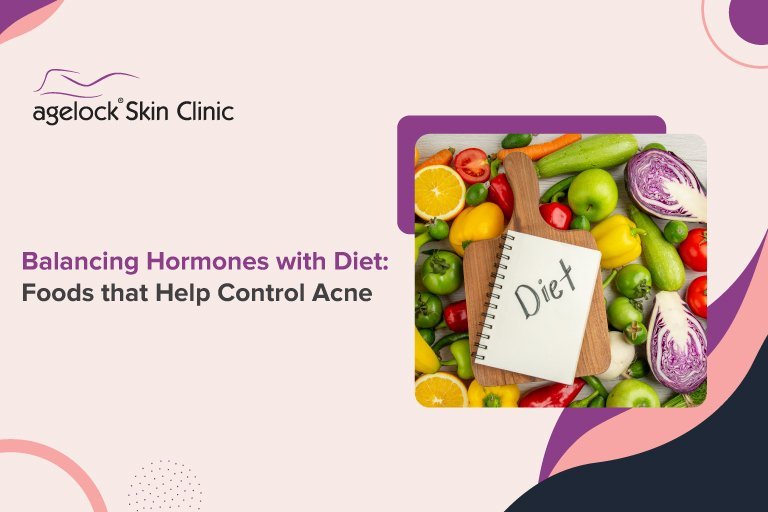 Balancing Hormones with Diet: Foods that Help Control Acne
