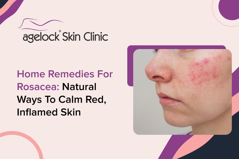 Home Remedies for Rosacea: Natural Ways to Calm Red, Inflamed Skin