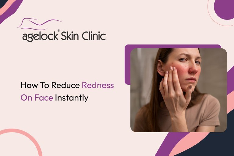 How To Reduce Redness On Face Instantly