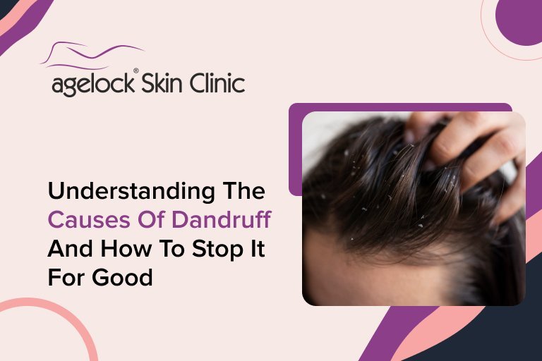 Understanding the Causes of Dandruff and How to Stop It for Good