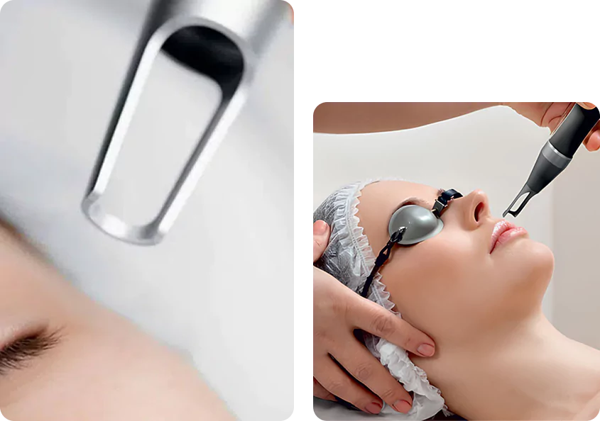 Pico laser treatment in Chandigarh