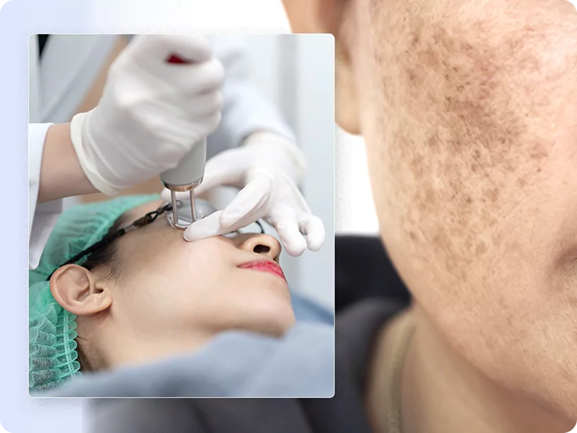 What is pico laser treatment