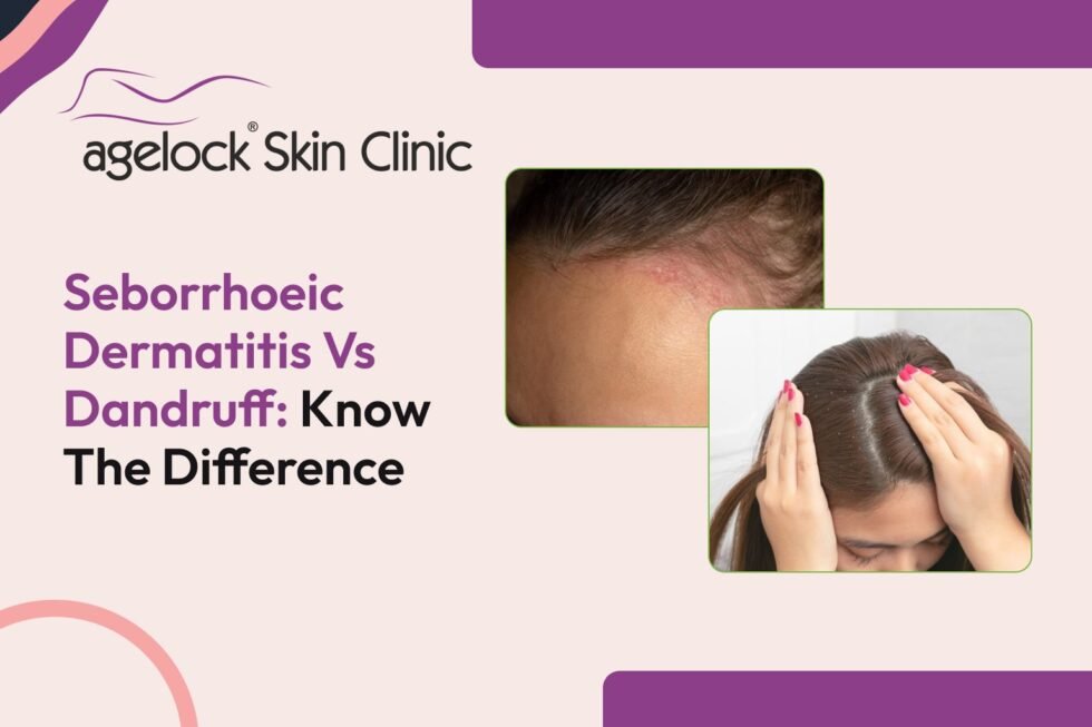 Seborrhoeic Dermatitis Vs Dandruff: Know The Difference