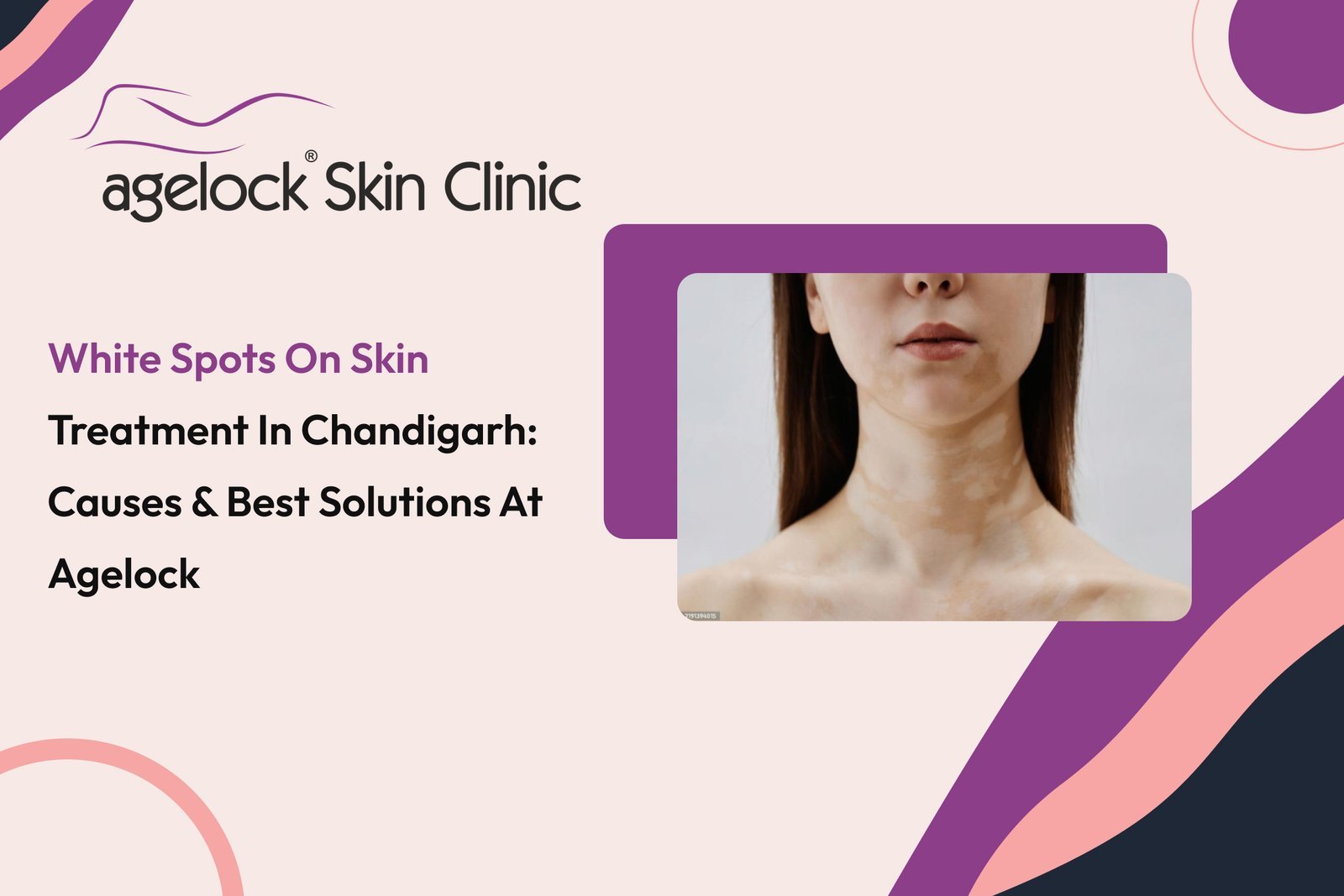White Spots On Skin Treatment In Chandigarh_ Causes & Best Solutions At Agelock (1) White Spots On Skin Treatment In Chandigarh: Causes & Best Solutions At Agelock