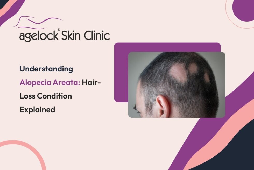 Understanding Alopecia Areata: Hair-loss Condition Explained