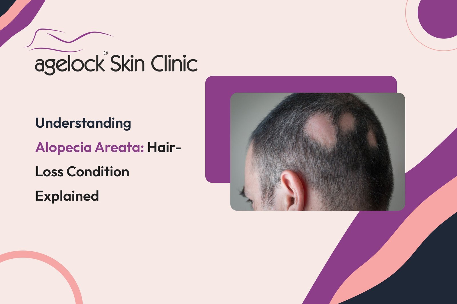 Understanding Alopecia Areata: Hair-loss Condition Explained Understanding Alopecia Areata: Hair-loss Condition Explained