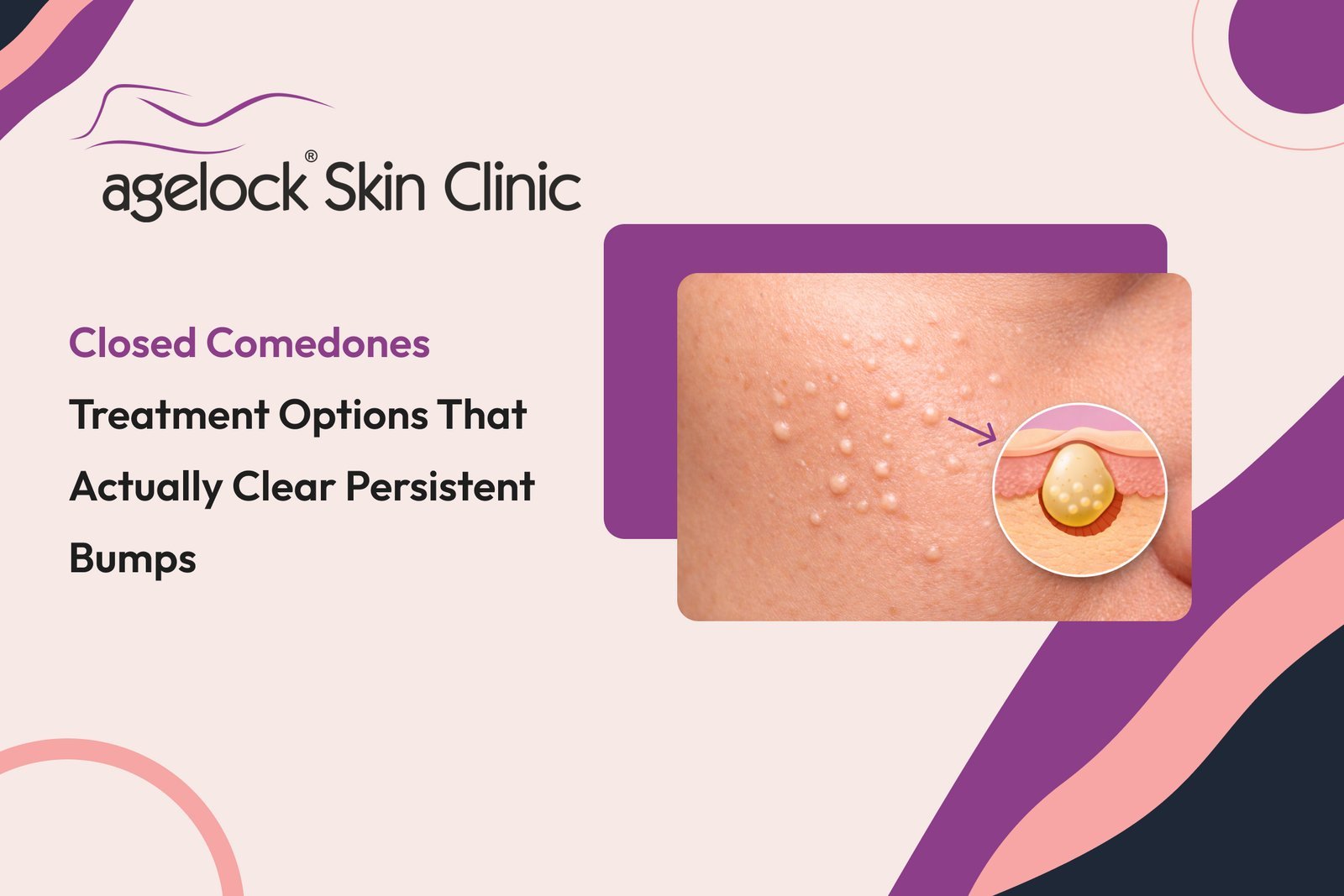 Closed comedones treatment options that actually clear persistent bumps