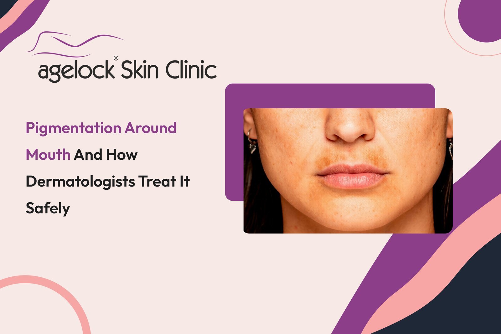 Pigmentation around mouth and how dermatologists treat it safely 2