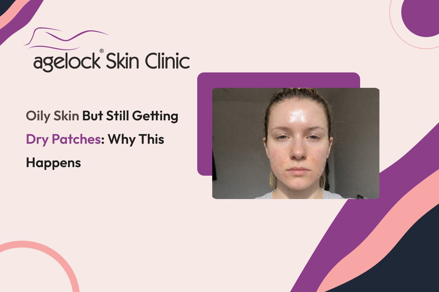 Oily Skin but Still Getting Dry Patches: Why This Happens