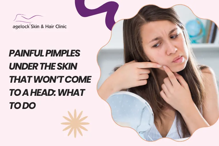 Painful Pimples Under the Skin That Won’t Come to a Head: What to Do