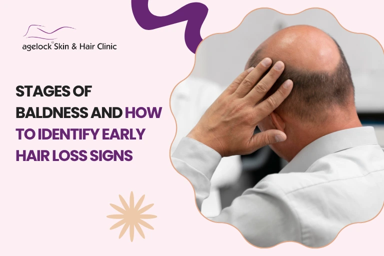 Stages Of Baldness And How To Identify Early Hair Loss Signs