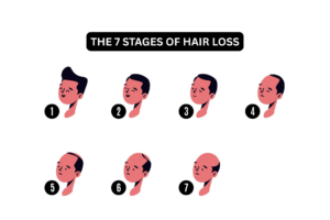 A picture showing the 7 stages of hair loss