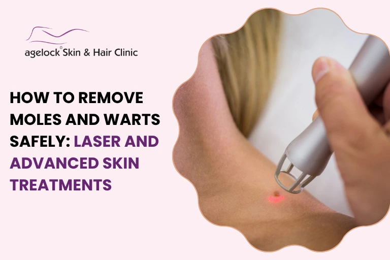 How to Remove Moles and Warts Safely: Laser and Advanced Skin Treatments