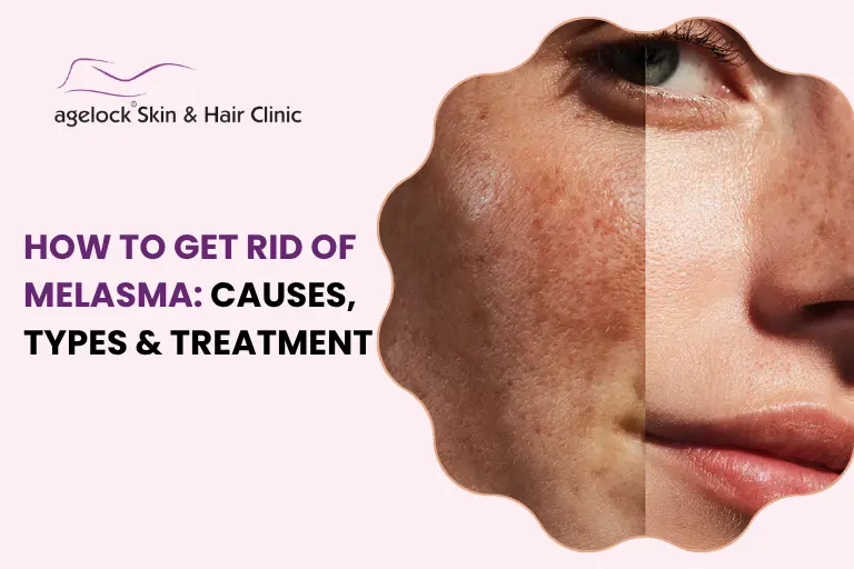 How to Get Rid of Melasma: Causes, Types & Treatment