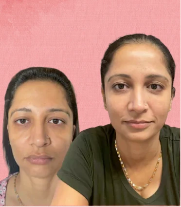 Anti-Aging Therapy before and after